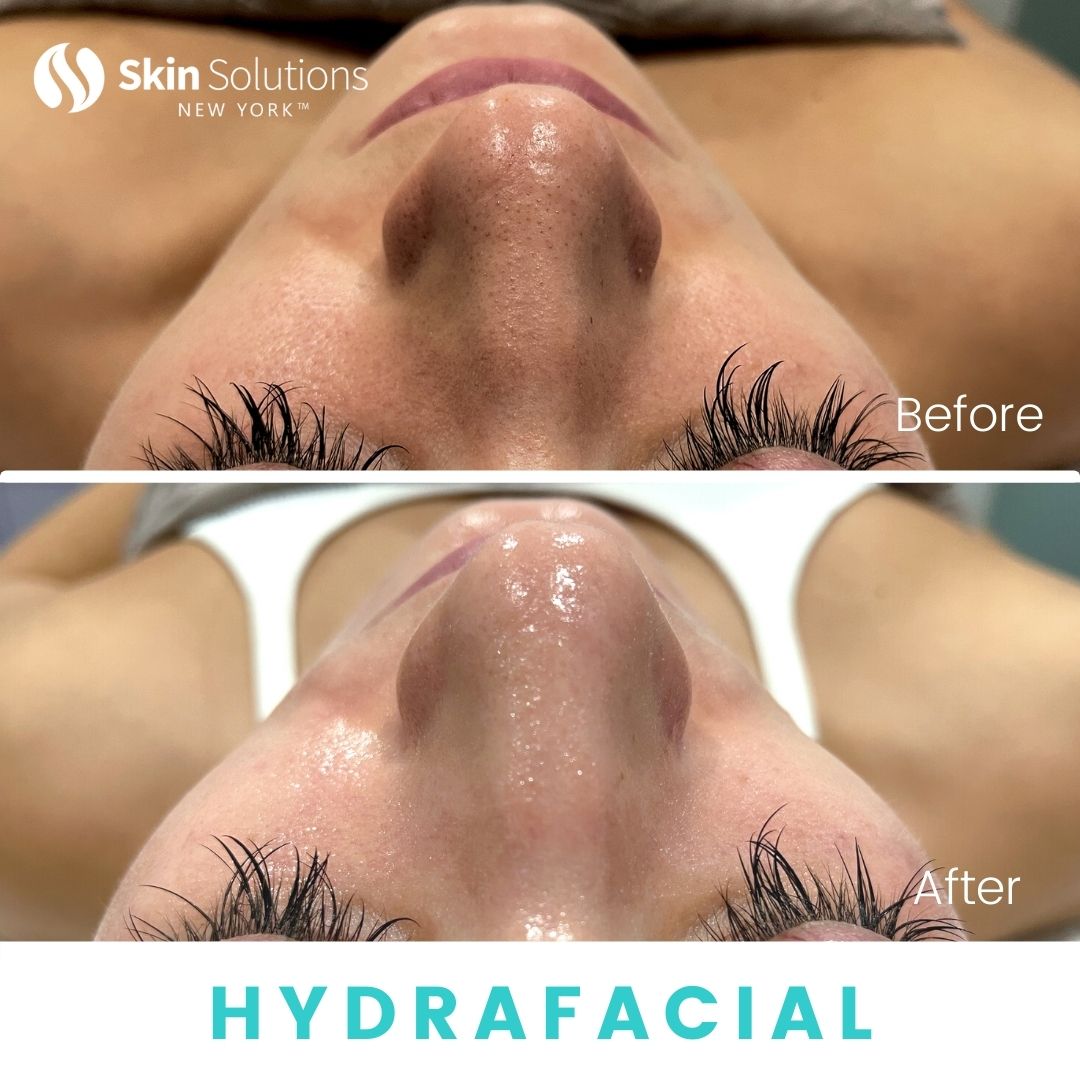 The SkinSol™ Hydrafacial [First Experience]