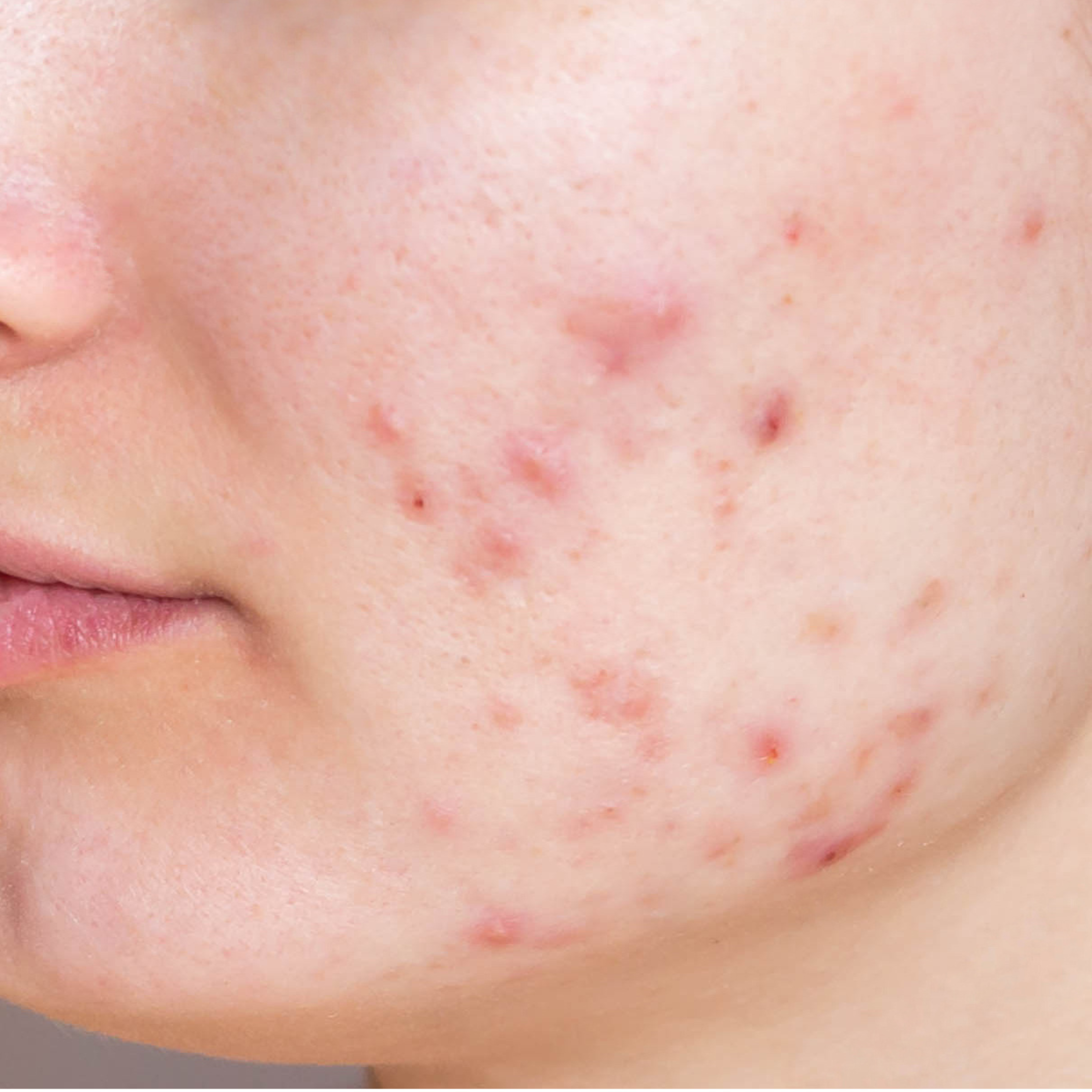 Acne/Acne Scars