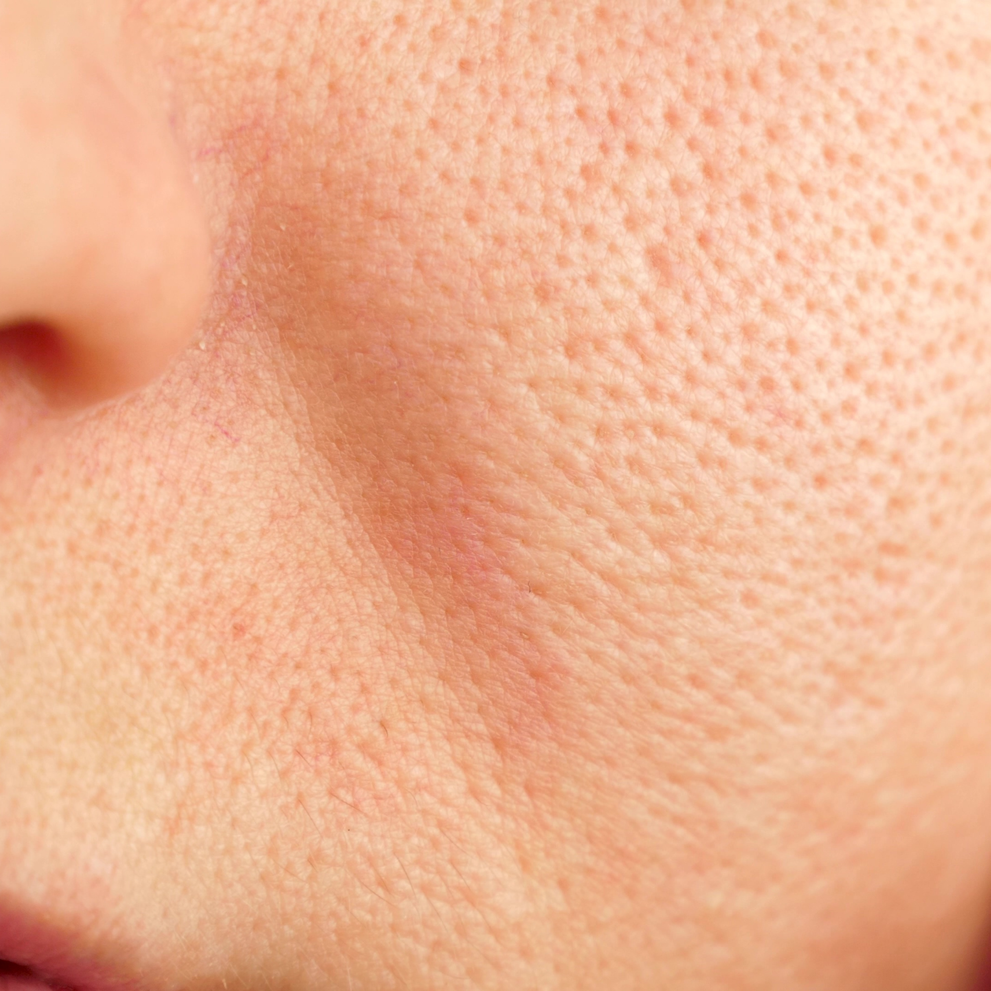 Enlarged Pores