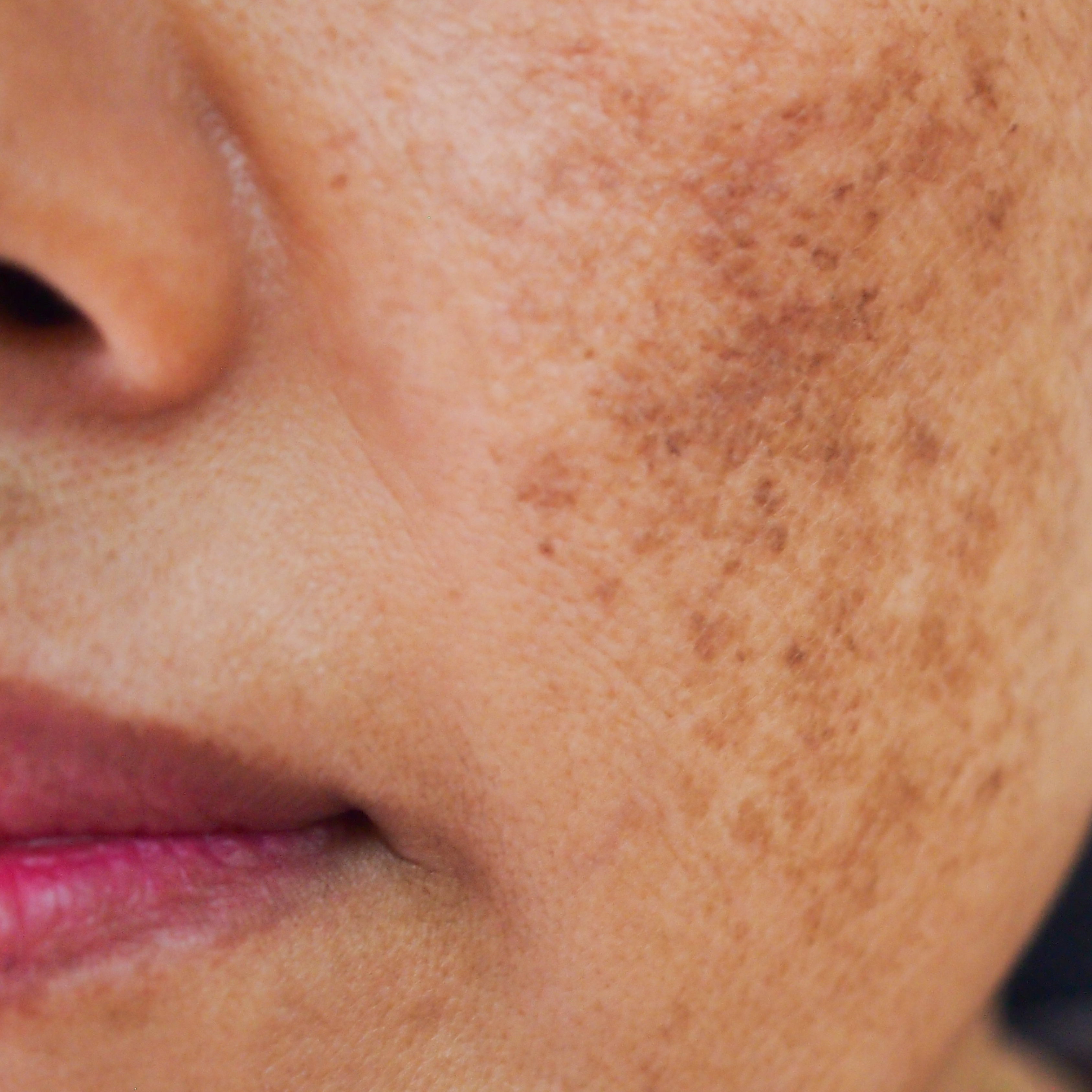 Dark Spots/Melasma