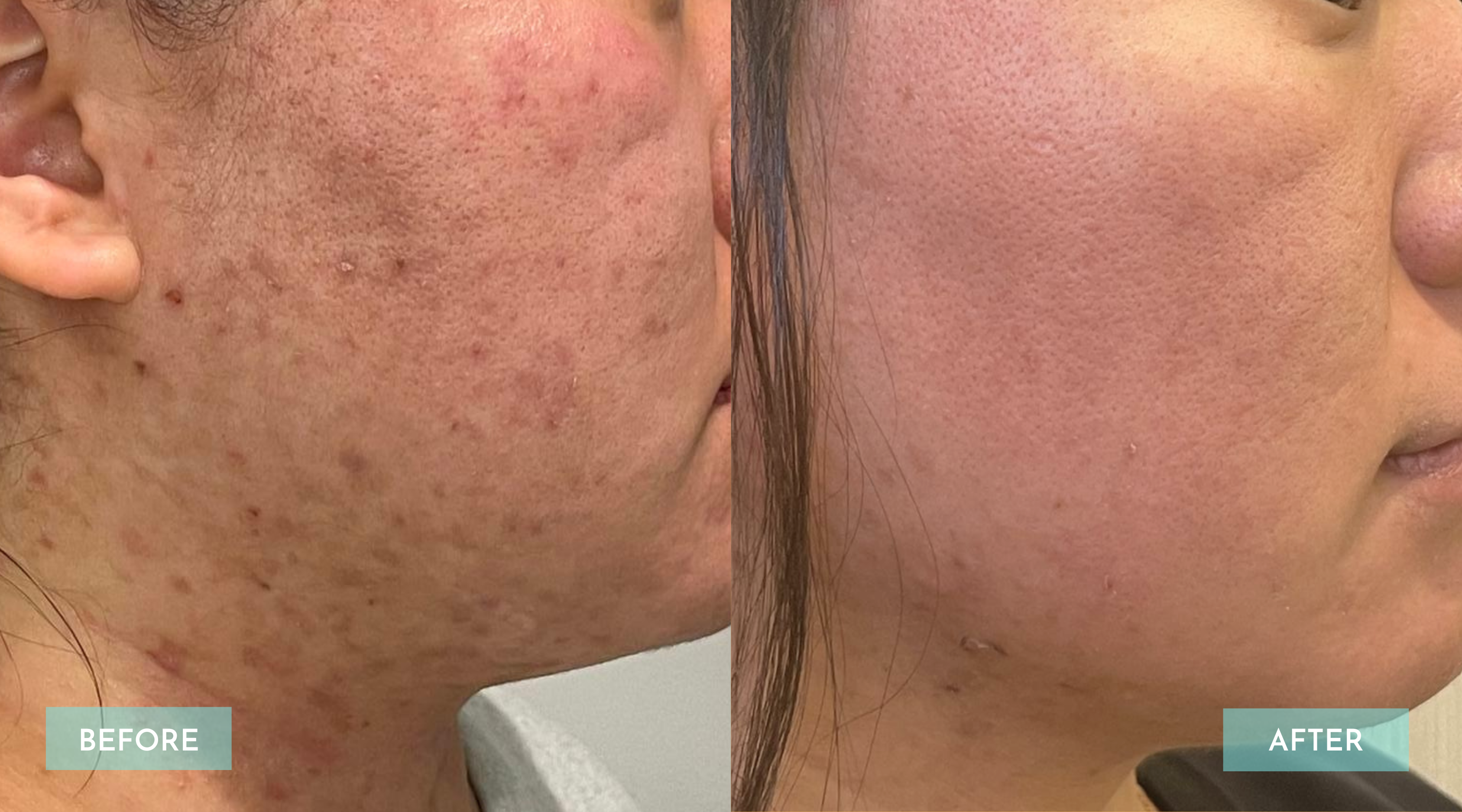 <p>Acne scar + Skin discoloration 3 Sessions</p>