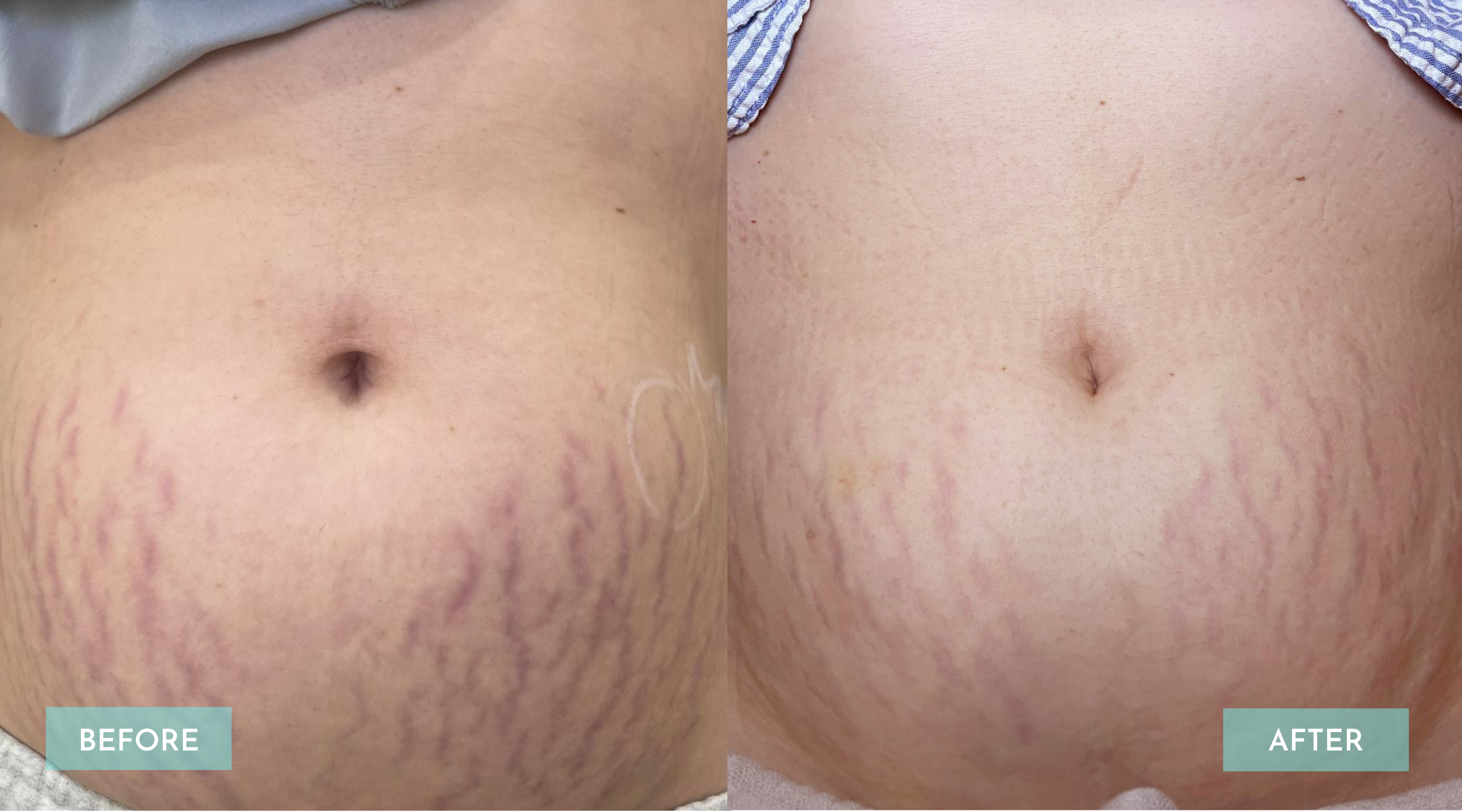 <p>Scar + Pigmentation 2 Session</p>