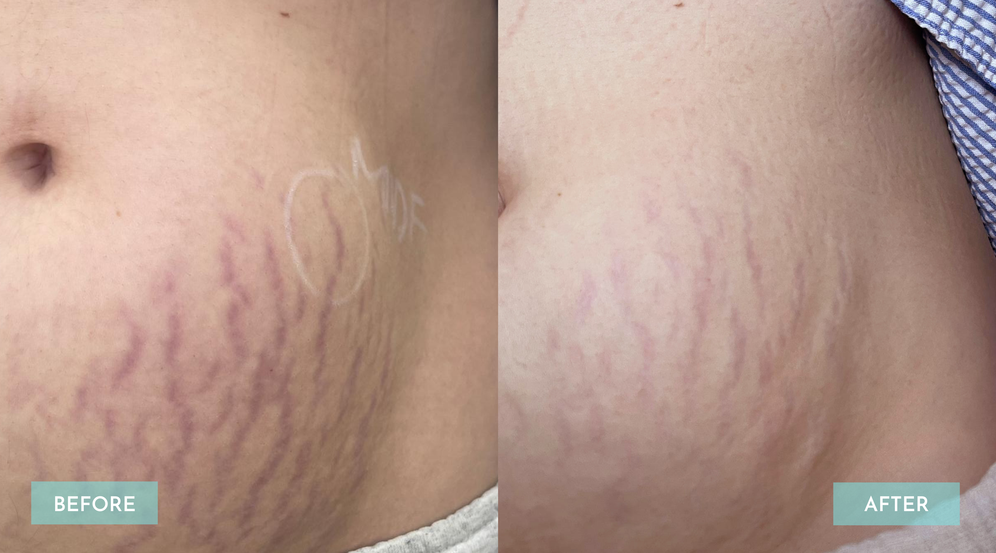 <p>Stretch Mark + Scar Revision 2 Session</p>