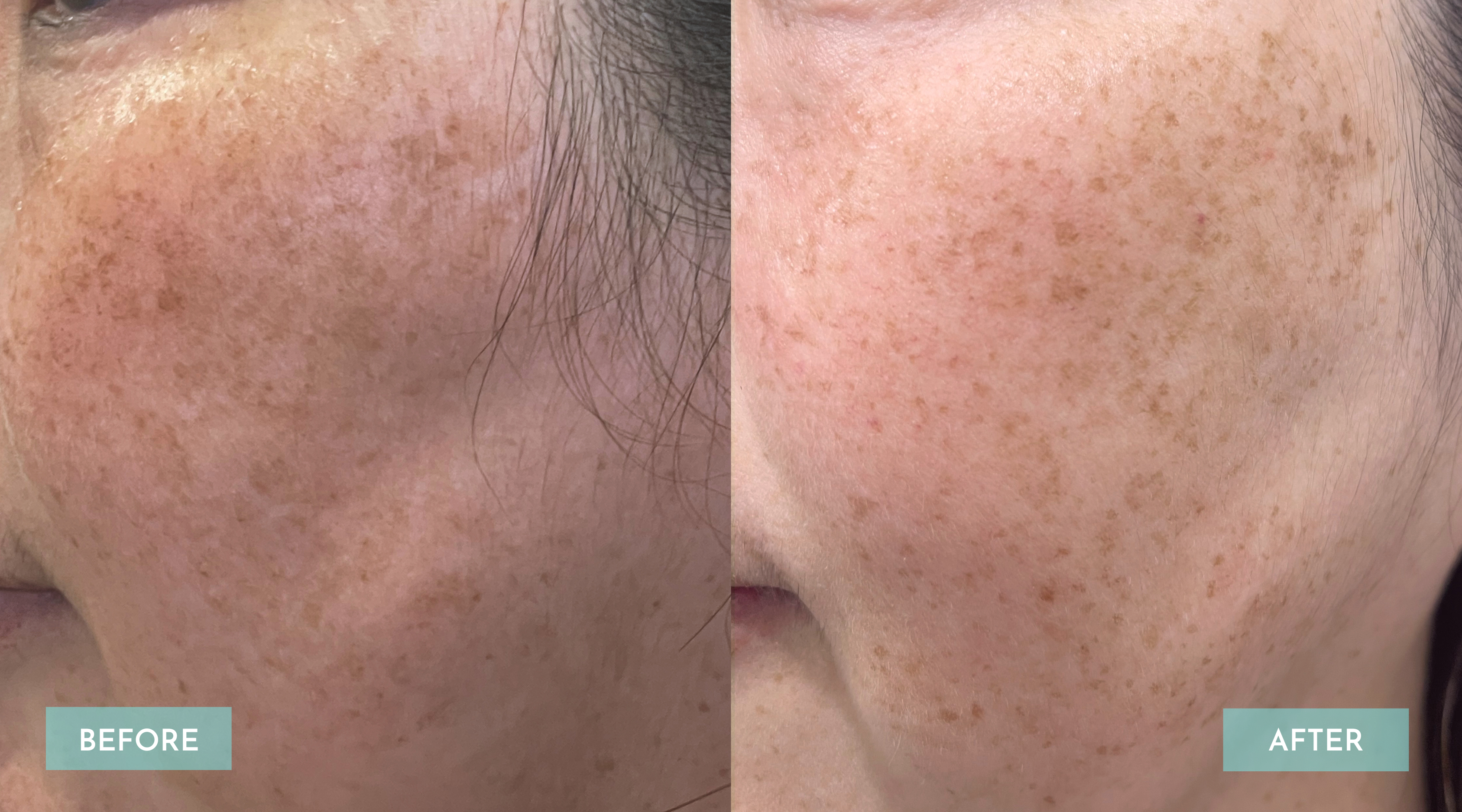 <p>Melasma 1 Session</p>