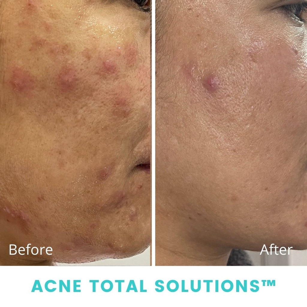 Soluciones totales para el acné SkinSol™