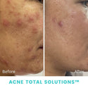 The SkinSol™ Acne Total Solutions