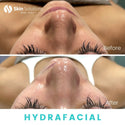 The SkinSol™ Hydrafacial