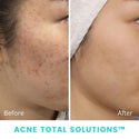 The SkinSol™ Acne Total Solutions