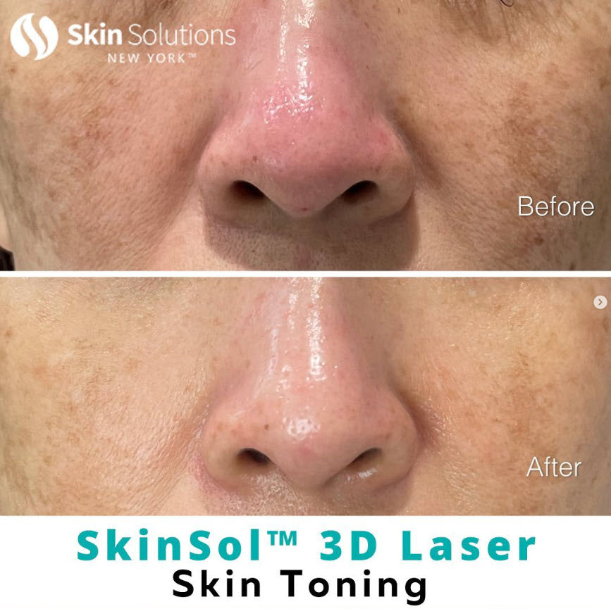 Programa de tonificación de la piel con láser 3D SkinSol™ - 0
