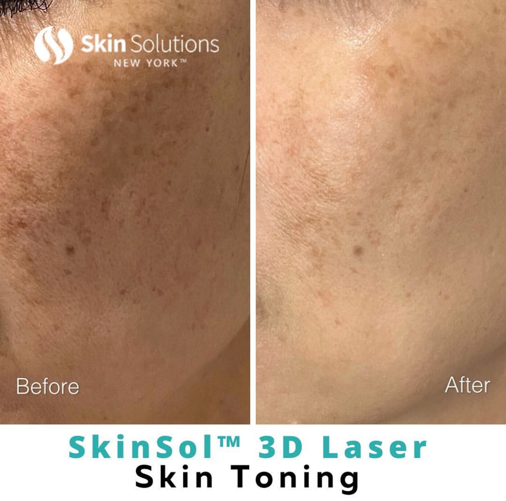 Programa de tonificación de la piel con láser 3D SkinSol™