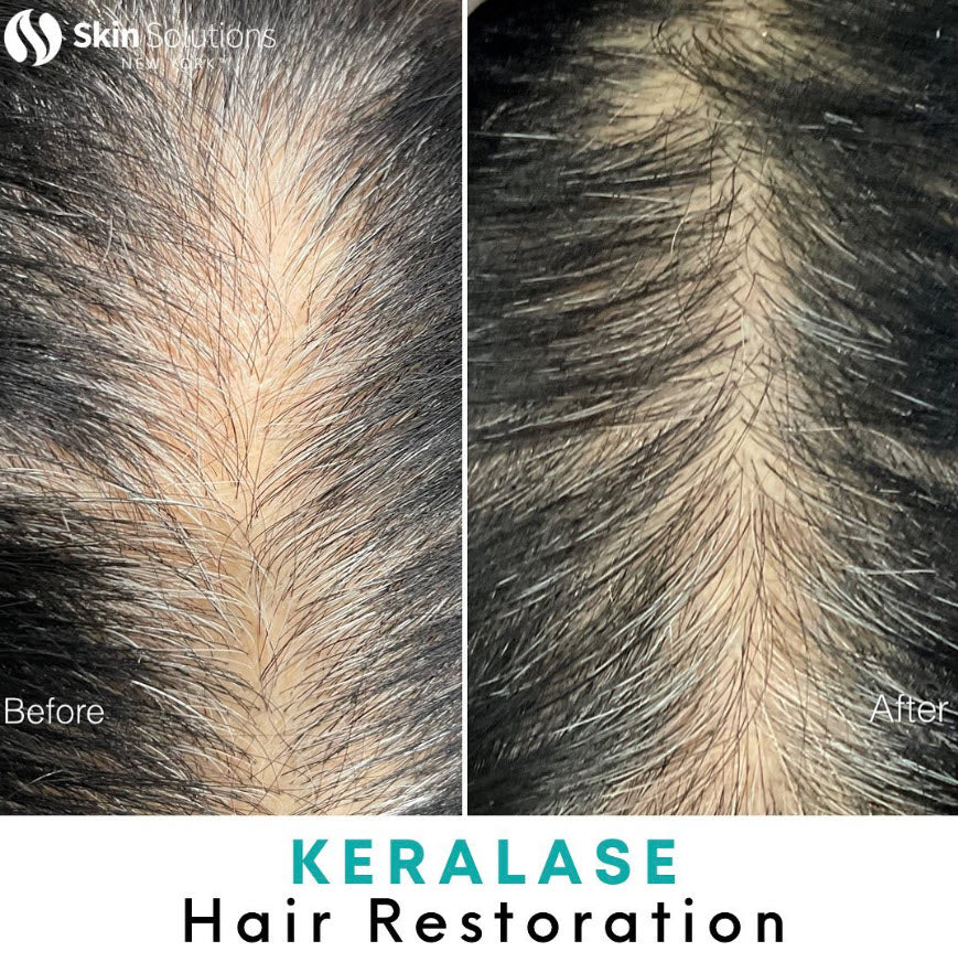 Keralase™ Hair Restoration-3