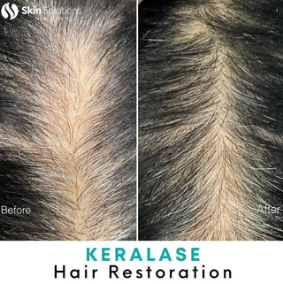 Keralase™ Hair Restoration